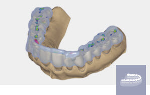 Exocad Module Gouttière - abonnement annuel