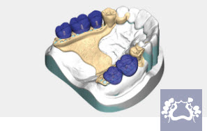 Exocad Module PartialCAD - abonnement annuel