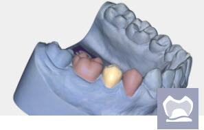 Exocad Module Provisoire - abonnement annuel